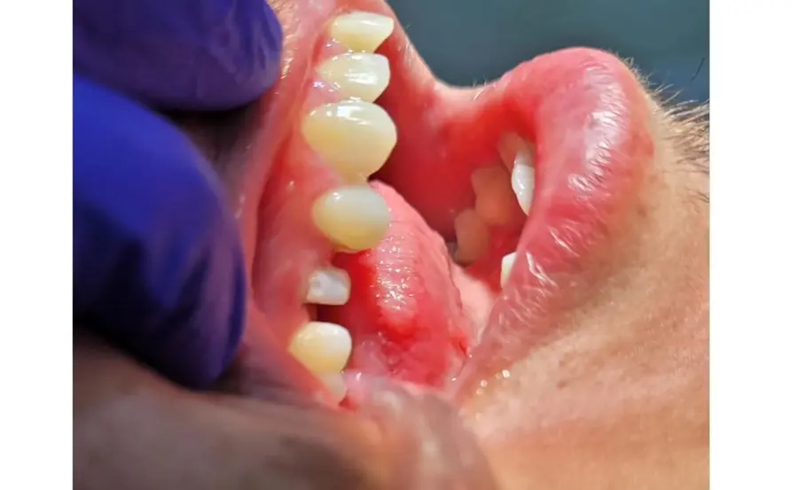 Reposición de corona dental fija: antes