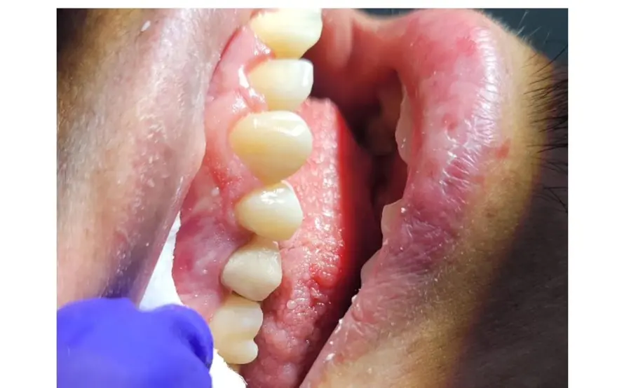 Reposición de corona dental fija: después
