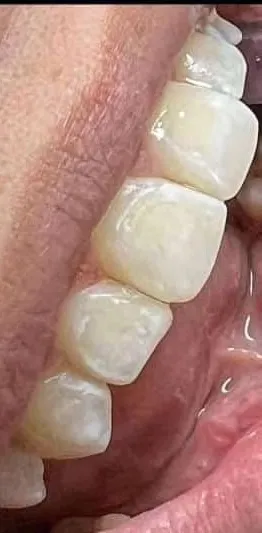 Caries interproximal restaurada con resina: después