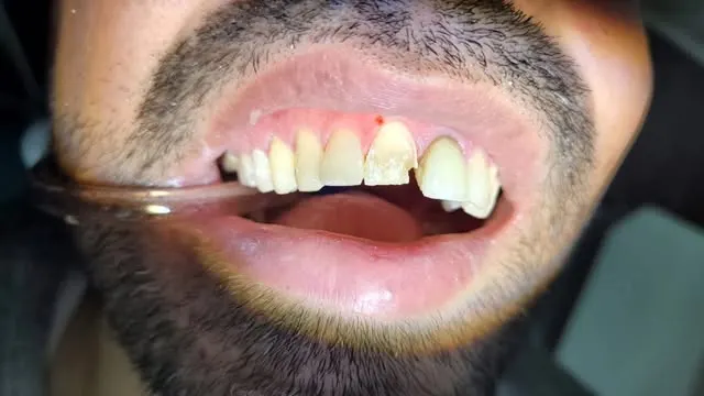 Restauración dental terminada